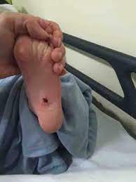 Girl 6 Left With Shard Of Glass Embedded Deep Inside Her Foot During Trip To Swimming Pool