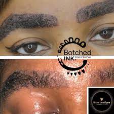 There were a couple times where the laser went outside of. Botched Ink Saline Tattoo Removal For Microblading Emergency