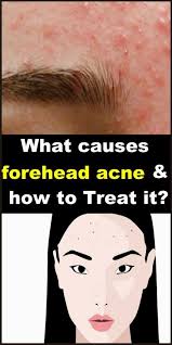 Beauty What Causes Forehead Acne And How To Treat It Forehead Acne Skin Care Pimples Acne