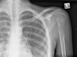 Types of biopsy procedures used to diagnose bone cancer include: Osteosarcoma Of Humerus Radiology Case Radiopaedia Org