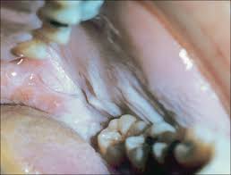 Image result for Leukoedema