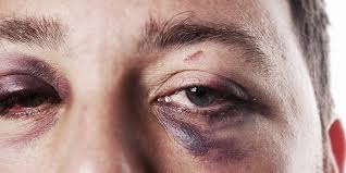 Salt water solution for treating swollen eye lids a solution of warm water and salt helps to draw out water retained in the eyes in a process similar to osmosis. The Best Way To Heal A Black Eye Men S Health
