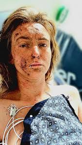 Challenges faced by left-handed people with injuries