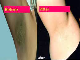 We did the homework to help you save time and money when choosing a dark spot corrector. Tips To Get Rid Of Dark Armpits Naturally For Android Apk Download