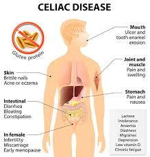 Celiac Disease Other Food Allergies Celiac Symptoms Lactose And Gluten Intolerance Symptoms Gluten Free Diet And More University Health News Lyme Disease Symptoms Graves Disease Celiac Disease Symptoms