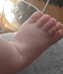 Image result for Clubbing nails feet