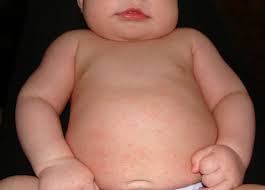 Image result for sweat rash on back baby