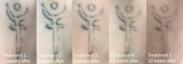 25:44 asmr anil çakmak recommended for you. Progress 6 Picoway Treatments In 10 Months On 10 Year Old Amateur Hand Tattoo Tattooremoval