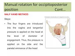 Image result for Manual Rotation in Occipitoposterior Presentation