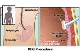 Gastrostomy Tube G Tube For Parents Nemours Kidshealth