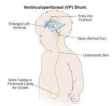 Brain tumors can occur in both children and adults; Brain Tumors In Children Symptoms Diagnosis And Treatment
