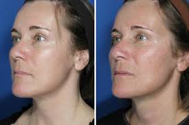 Ultherapy Face and Upper Neck Case 3
