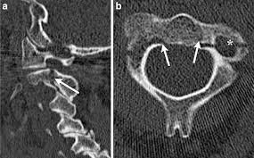 Hangman S Fracture Wikipedia