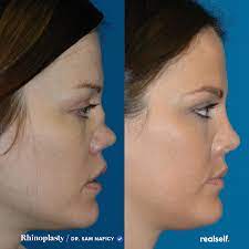 Rhinoplasty: The Ultimate Guide to Nose Jobs - RealSelf | Rhinoplasty,  Rhinoplasty cost, Rhinoplasty recovery