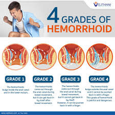 Image result for Hemorrhoid
