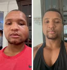 California man who shattered EVERY bone in his face after falling from  three-storey balcony