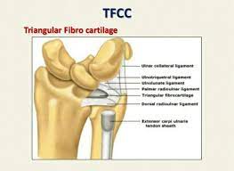 Of partial tfcc excision when concomitant ulnar shortening is not performed; The Triangular Fibrocartilage Complex Tfcc Slide Vineet Srivastava Carpal Tunnel Surgery Radius And Ulna Triangular