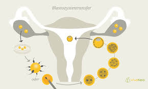 Ist doch auch oft altes blut das eben erst nach 1,2 tagen zu sehen ist. Blastozystentransfer Embryotransfer Alle Infos Vivaneo