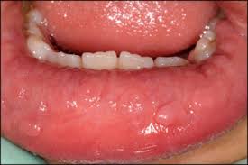 Așa este și cazul pacienților. Cancerul Hepatic Carcinomul Hepatocelular Constiintaortodoxa Ro Cancer Hepatic Stadiul 4