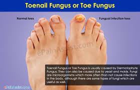 toenail fungus risk factors treatment