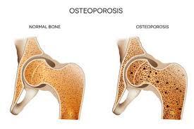 Find out more about the causes, symptoms and risk factors. Osteoporosis Frequently Asked Questions