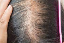 Once transplanted, the hair grows normally. Signs Of Hair Loss And What To Do About It Blog Keranique