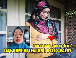 √ scientific base pass quality & scientific checked by redaction team, read our quality control. Hamil 9 Bulan Faye Kusairi Lumpuh Sebelah Muka Kenali Apa Itu Penyakit Bell S Palsy