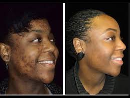 Pin On Hyperpigmentation