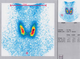 Dies macht man sich bei der schilddrüsenszintigraphie zu nutze. Https Www Thieme Connect De Products Ebooks Pdf 10 1055 B 0036 137120 Pdf