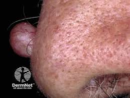 Image result for skin cancer on nose pimple