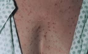 Image result for Papular urticaria