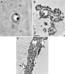 Randall's plaque: Pathogenesis and role in calcium oxalate nephrolithiasis  - Kidney International