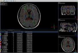 Convertește 1.000 eur în ron cu convertorul de monede transferwise. Diffusion Tensor Imaging For Assessment Of Normally Appearing White Matter Of The Brain And Spinal Cord In Cases Of Multiple Sclerosis A Multi Parametric Correlation In View Of Patient S Clinical Status Egyptian