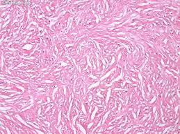Segal a, sterrett gf, frost fa, et al. Webpathology Com A Collection Of Surgical Pathology Images