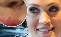 Carrie Underwood reveals scar on lip as she worries disfigurement ...