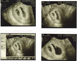 Unfortunately, seeing no yolk sac at 6 weeks can also be a sign of miscarriage. Twins At 6 Weeks What S Like In Ultrasound Pictures New Kids Center