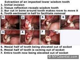 The initial recovery and healing from wisdom tooth extraction usually occurs over about three to five days. Dr Jeffrey Dorfman Dentist