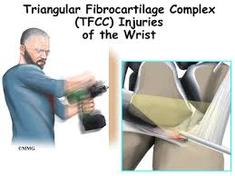 Learn how to see all the different components of the tfcc and how to find them on mri. Patient Education Concord Orthopaedics