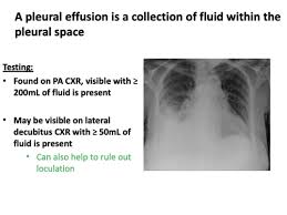 The effusion, in this case, is restricted to one or more fixed pockets within the pleural space. Pleural Effusion Definition Quizlet
