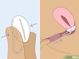 Image result for Contraceptive Sponge