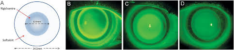 The laserfit lens is digitally. Contact Lens Management Of Keratoconus Downie 2015 Clinical And Experimental Optometry Wiley Online Library