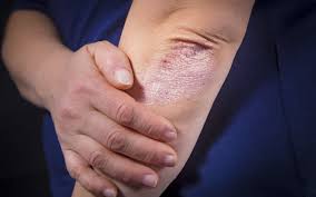 Psoriasis is a skin condition that leads to rashes with clearly defined borders and scaling. Psoriazis Forum 2019 Despre ViaÈ›a Din Romania