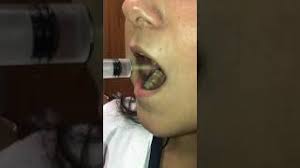 Final thoughts if you're wondering how long does pain after wisdom tooth extraction last, hopefully you're now more at ease. After Wisdom Tooth Removal Home Instructions Virginia Oral Facial Surgery