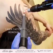 But, before applying tattoo removal cream you must keep in mind that these types of cream contain trichloroacetic acid. Can Microneedling Remove Tattoo