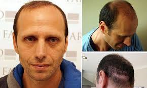 Surgeon leaves man scarred and bald after botching hair transplant SIX  times