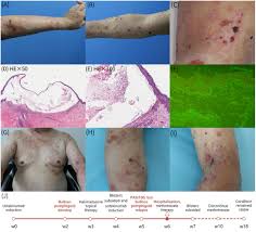 Image result for Pemphigoid