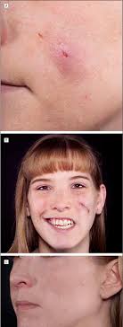 Nor is there any vaccine against it. Pdf Botulinum Toxin Induced Immobilization Of Lower Facial Wounds Semantic Scholar