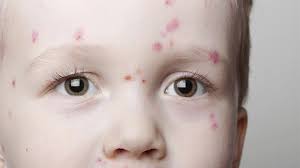 Les causes de ces boutons sur le visage. Mon Enfant A T Il Un Zona Magicmaman Com