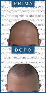 Dell'intervento di tatuaggio capelli e più probabile sarà . Tricopigmentazione Capelli A Padova Vicenza Milano Verona Brescia E Trento Soluzione Definitiva Calvizie Informati Sui Costi Vantaggiosi Della Micropigmentazione Anche Dal Tuo Tricologo