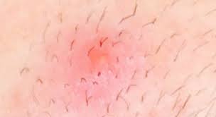 Ingrown hairs can happen anywhere hair grows on the body. Why Are There Two Hairs In One Follicle It S Not Shaving